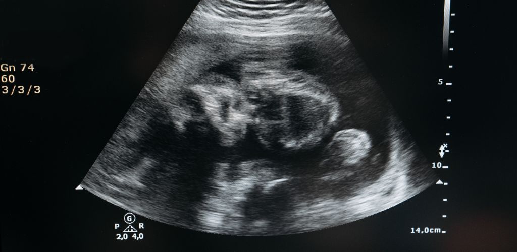 IUI Treatment: A Ray of Hope.